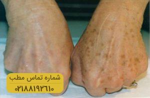 چرا لکه های قهوه ای روی پوست ایجاد می شوند؟