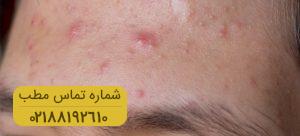 مقابله با آکنه در دوران نوجوانی