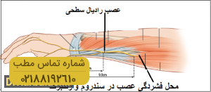 عصب رادیال ؛ بیماری ها و درمان آن چگونه است