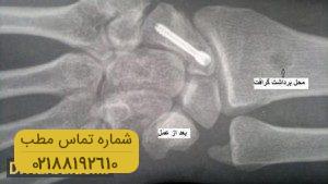 شکستگی استخوان اسکافویید