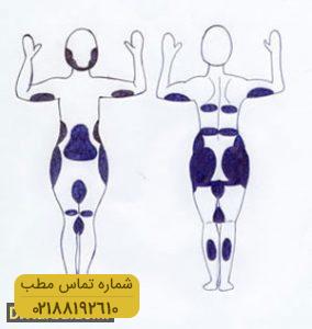 لیزر لیپولیز