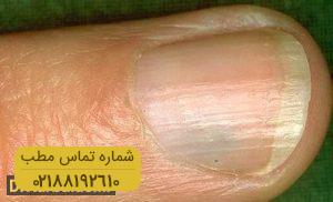 تومور گلوموس