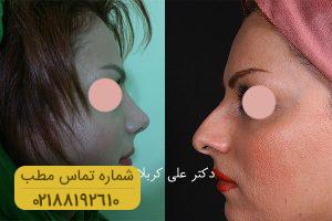 گالری جراحی های بینی