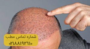 اطلاعاتی که باید قبل از عمل پیوند مو بدانید