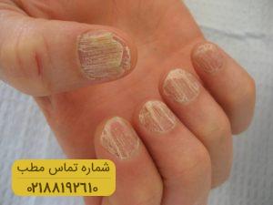 آنیکولیسیس چیست؟ علائم و راه درمان آن