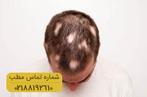 اطلاعاتی در خصوص ریزش مو سکه ای