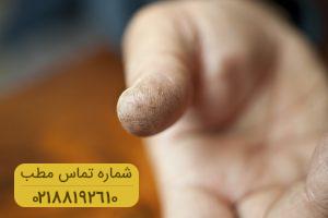 تمام آنچه که باید در خصوص درمان ترک های پوستی بدانید