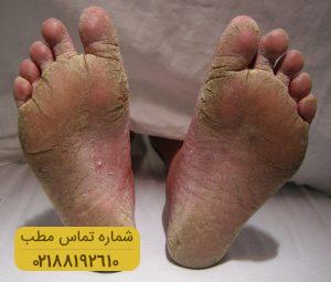 ارتباط ۶ بیماری با ترک پاشنه پا