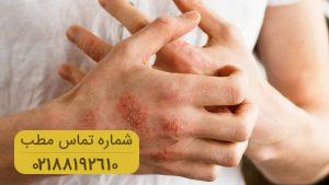 قارچ پوستی را با محصولات طبیعی برطرف کنید