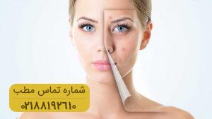 از بین بردن زخم های آکنه با چند روش خانگی