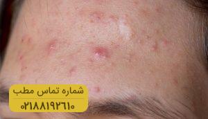 چگونه از شر جوش صورت خلاص شویم