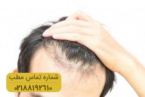 پس از پیوند مو چه اتفاقاتی می افتد؟