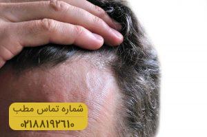 ۱۰ کلید طلایی برای جلوگیری از ریزش مو و حفظ سلامتی آنها