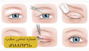 جراحی زیبایی پلک