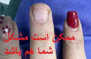 علت درد ناخن در تومور گلوموس چیست